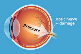 Some people have narrow drainage angles, putting them at. 3 Main Causes Of Glaucoma
