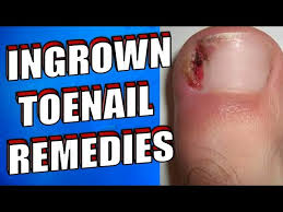 what is an ingrown toenail 8
