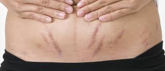 stretch marks causes prevention