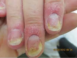 2 nail bed psoriasis features of