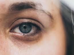 puffy eyes meaning symptoms causes