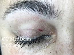 eyelid ps surgeries cosmetic