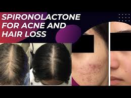spironolactone for acne and hair loss