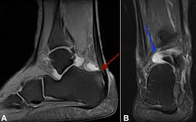 We may consider surgery to remove your bump and repair your achilles tendon. Epos Trade