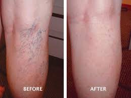 cosmetic sclerotherapy for spider veins