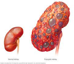 Htn affects ± 60 million in the us workup evaluation of htn requires clinical hx for pt, family hx, 2 bp. End Stage Renal Disease Symptoms And Causes Mayo Clinic