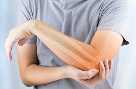 triceps tendonitis causes treatment