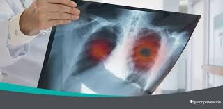 Cáncer de pulmón de origen laboral | Blogs