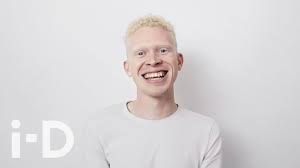 Breaking Down Albinism With Jordan Charles I D