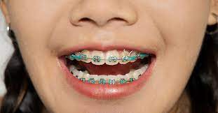 You are bound to hurt yourself by trying to remove braces work by moving teeth to the desired position. Braces With Rubber Bands Purpose And How Long They Stay On