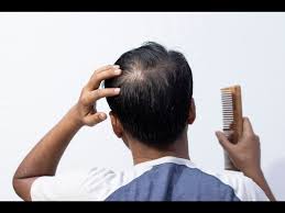 hair loss treatment ruin your life