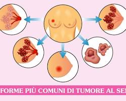 Tumore al seno invasivo
