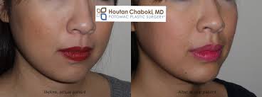 reduce swelling after lip injections