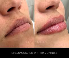 introducing rha lip filler
