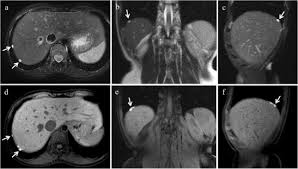 Endometriosis can affect women of any age. Endometriosis Clinical Features Mr Imaging Findings And Pathologic Correlation Abstract Europe Pmc