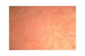 how to id common rash symptoms