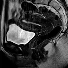 dynamic mr imaging of pelvic floor