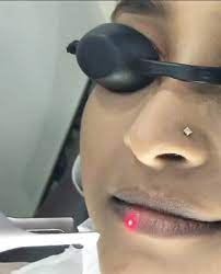 laser for dark lips dr shaista lodhi
