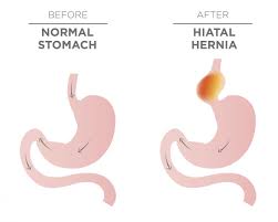 Hiatal Hernia Surgery Procedure Recovery And Outlook