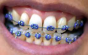 Cavities are among the most common problems dental patients experience. File Braces Smile Purple Jpg Simple English Wikipedia The Free Encyclopedia
