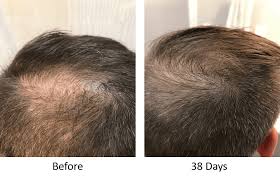 stem cell therapy for hair loss