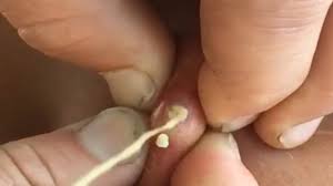 blackheads cyst popping wart removal