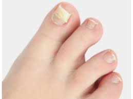toenail fungus or ingrown toenail