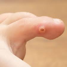 plantar wart treatment foot ankle