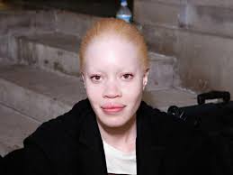 diandra forrest albino model