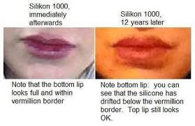 as you age your lips will lose volume