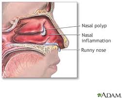nasal polyps information mount sinai