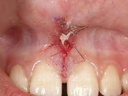上唇小帯について - つしまスマイル歯科クリニック