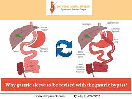 why is vertical gastric sleeve revised