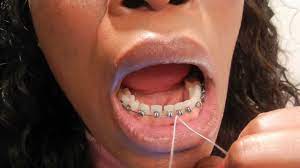 How to make diy braces. 32 How To Floss With Braces Flossing Teeth With Braces Braces On Youtube