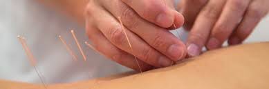 acupuncture in pain management