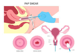 cervical health and pap smears all you