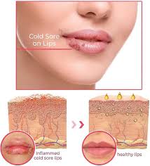 cold sores therapy oil lip care cold