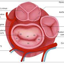 Normally, the mitral valve prevents blood flowing back into the left atrium from the left ventricle. Atrial View Of Mitral Valve Components Of Mitral Valve Apparatus And Download Scientific Diagram