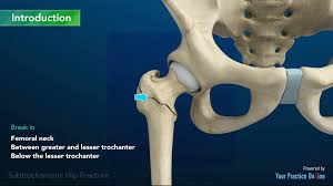 subtrochanteric hip fracture video