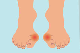 So we've put together an overview of the most common and interesting bumps together with the appropriate treatment for each. Bunion Misdiagnosis Health Problems You Can Mistake For Bunions