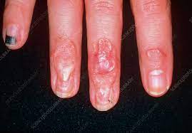 scars on fingers due to crushing injury