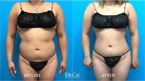 how much does liposuction cost