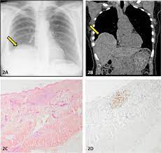 The main utility of ct scans is to rule out the presence of a cervical or intrathoracic tumor as the cause of phrenic nerve paralysis. Thoracic Endometriosis Syndrome Other Than Pneumothorax Clinical And Pathological Findings The Annals Of Thoracic Surgery