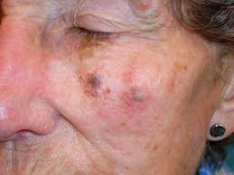 The mutations can quickly cause cells to grow out of control and turn into a mass. Melanoma Symptoms Pictures Causes And Treatments