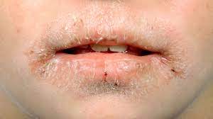 psoriasis on lips symptoms treatment