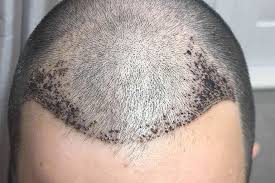 how can i get rid of hair transplant scabs