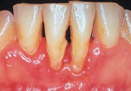 Hình ảnh Viêm chân răng mức độ nặng