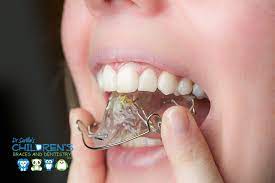 When you first get your braces off or finish your clear aligner treatment, your orthodontist will provide when you reduce retainer wear to nightly use, you'll store your retainer safely in a case for the day, and then put the retainer in after brushing your teeth. Will Your Teeth Move Back If You Forget Your Retainer