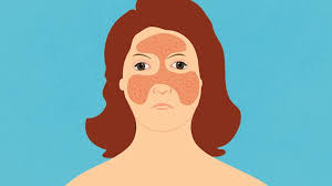 rashes and other lupus skin