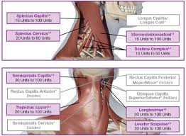 Cervical Dystonia Dosing And Administration Botox